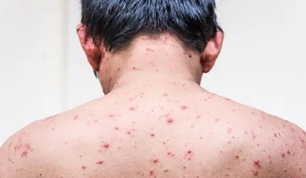 علائم آبلهمرغان در بزرگسالان علائم آبلهمرغان در بزرگسالان